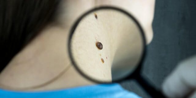 Basal Cell Carcinoma