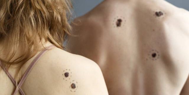 skin tags