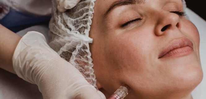 HALO laser resurfacing