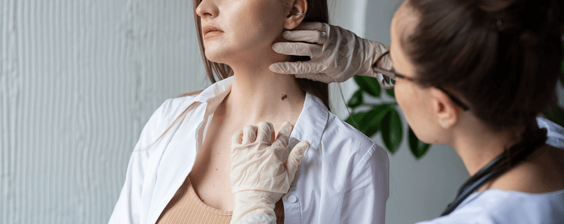 How Mole Removal Works and What to Expect