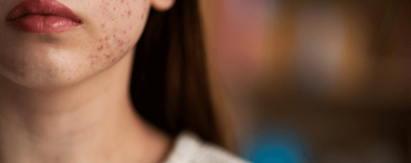 Setting Realistic Expectations for Skin Care Treatments for Acne Scars