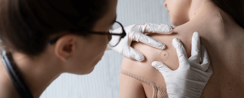 Understanding Approaches of Treatment for Melanoma