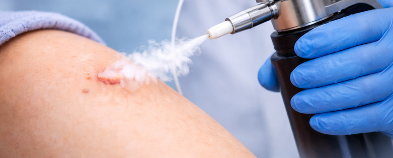 Cryotherapy Sydney: Fast, Effective Skin Lesion Treatment