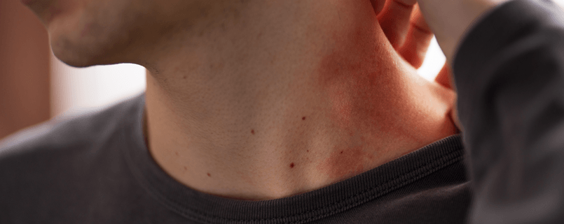 Fungal vs. Bacterial Skin Rash: How to Tell the Difference