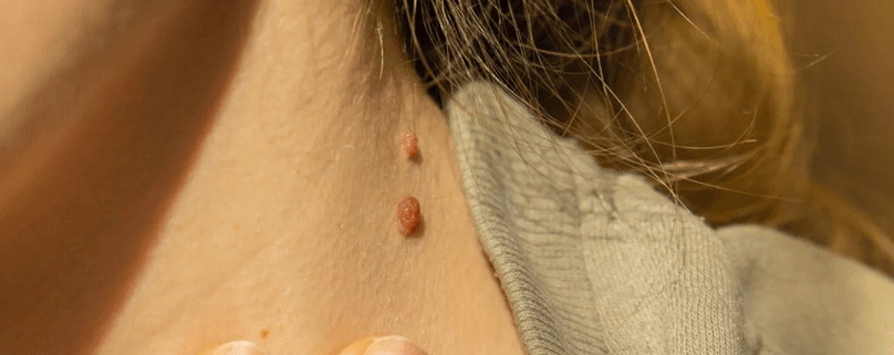 Skin Tag Removal: Simple Solutions for Clearer Skin