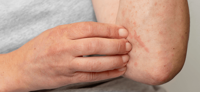 Close-up of an urticarial rash causing redness and irritation on the arm