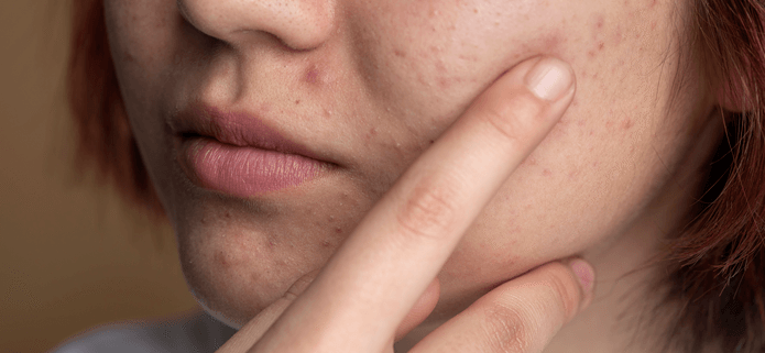 Why Won't My Acne Go Away? Common Causes and Treatment Options