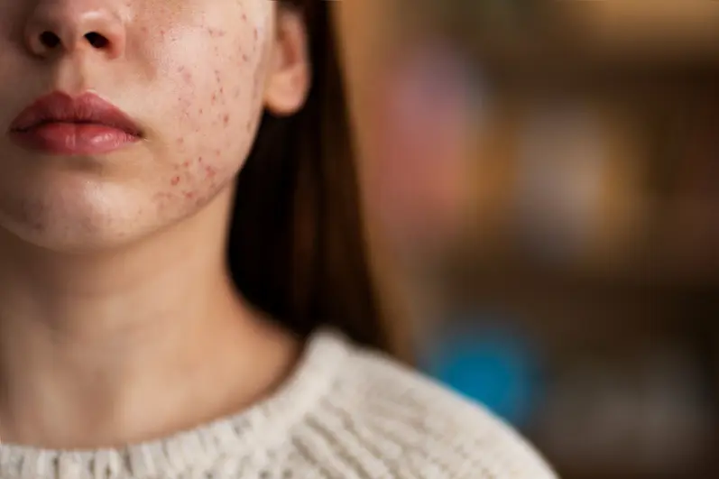 Close-up of a young woman with facial acne on her cheeks and chin.
